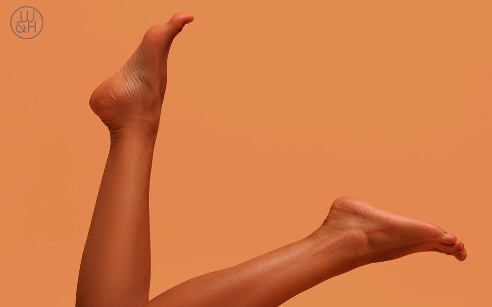 Venenleiden meiden! Was tun gegen lästige Besenreiser?