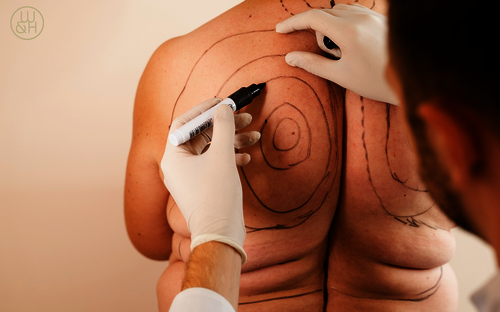 Fettabsaugung: Besonders effektiv bei hartnäckigen Fettpölsterchen