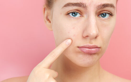 Haut & Hormone (Teil 3): Hautprobleme und Androgene