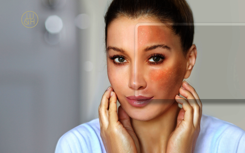 Das Melasma: Wenn Hormone Spuren im Gesicht hinterlassen