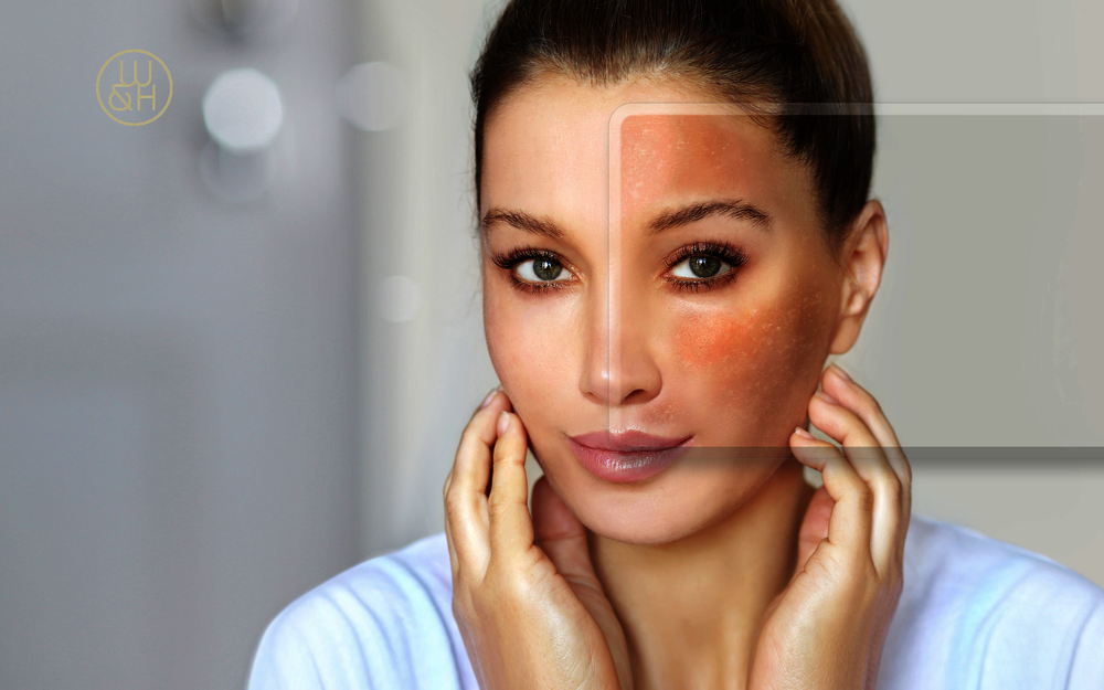 Das Melasma: Wenn Hormone Spuren im Gesicht hinterlassen