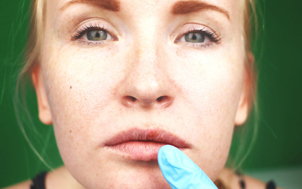 Fieberblasen und Co: Was tun, wenn der Herpes immer wiederkommt
