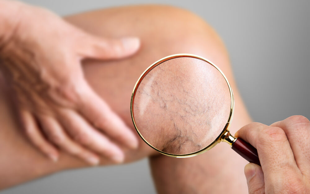 Venenchirurgie: Gezielte Behandlung von Venenleiden (Teil 2)