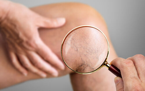 Venenchirurgie: Gezielte Behandlung von Venenleiden (Teil 2)