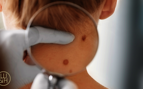 Sonne im Anmarsch – denk an deine Haut!