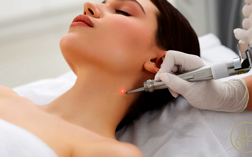 Falten, Narben und Co: Allroundtalent Laser