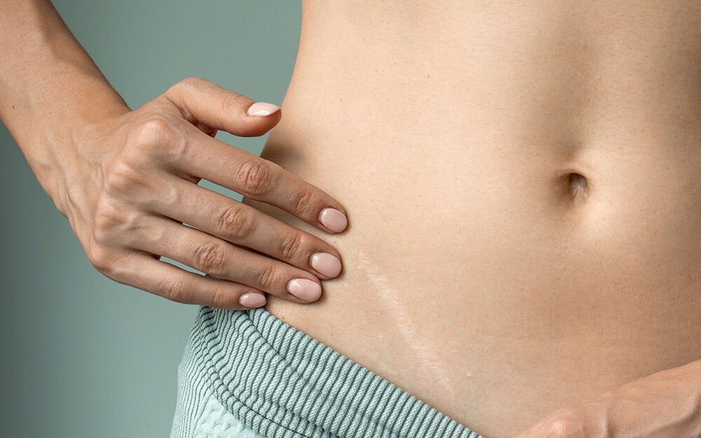 Neue Chancen für alte Narben: Moderne Narbenkorrektur