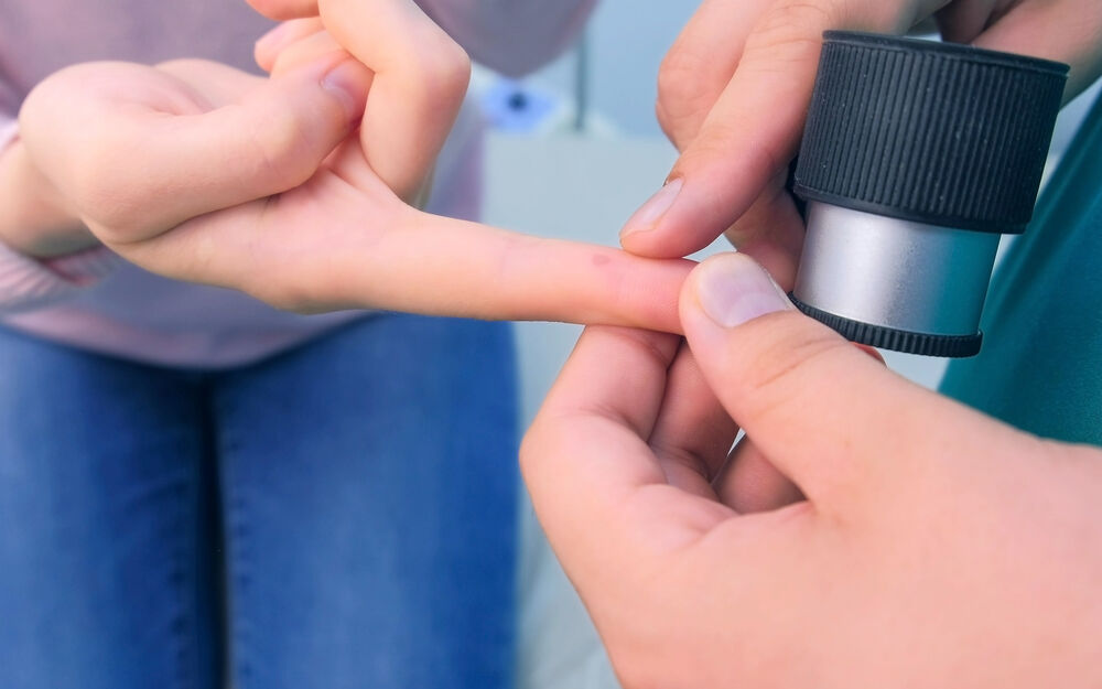 Warzen: Langfristig wirksame Hilfe gegen die hartnäckigen Hautveränderungen