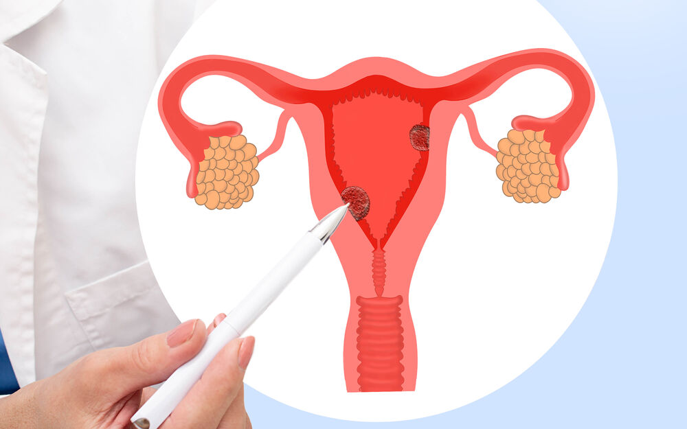 Gebärmutterschleimhaut-Polypen: Was tun?