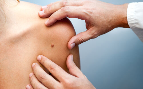 In guten Händen: schonende, sichere Hautkrebsentfernung